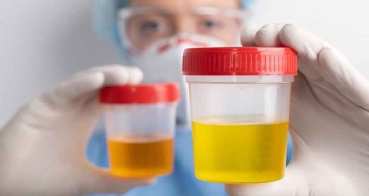 urine 20250714 092404827 - Bd Sylhet News