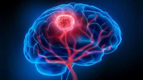 brain tumor2 20220820170224 - Bd Sylhet News