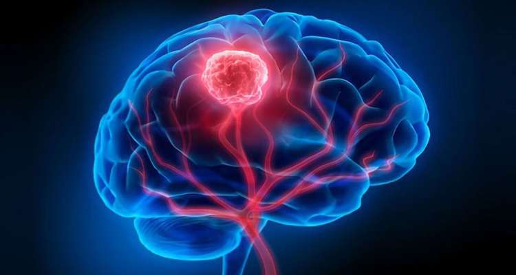 brain tumor2 20220820170224 - Bd Sylhet News